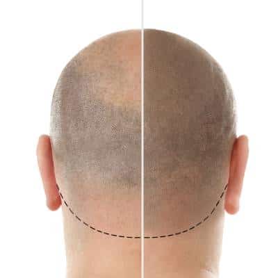 HAIR REPLACEMENTS