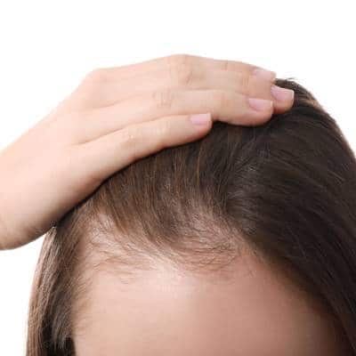 THINNING HAIR